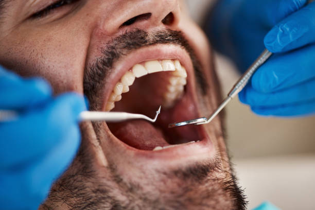 Best Emergency Wisdom Teeth Removal in Bagdad, FL