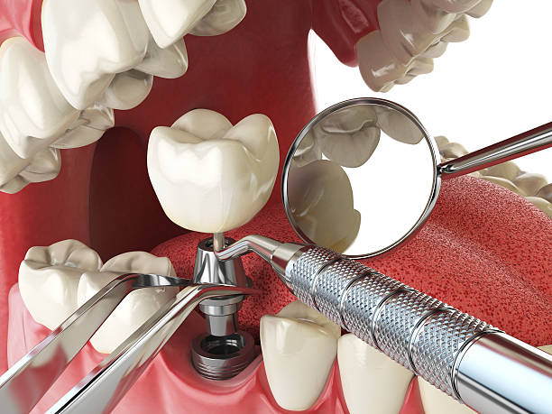 Best Emergency Dental Care for Broken or Chipped Teeth in Bagdad, FL